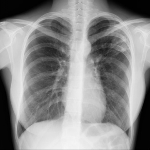 radiografie pulmonara pret)
